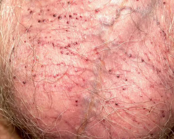 کیست خونی روی پوست بیضه