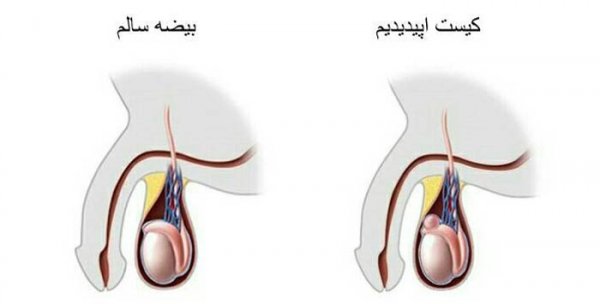  کیست خونی روی پوست بیضه