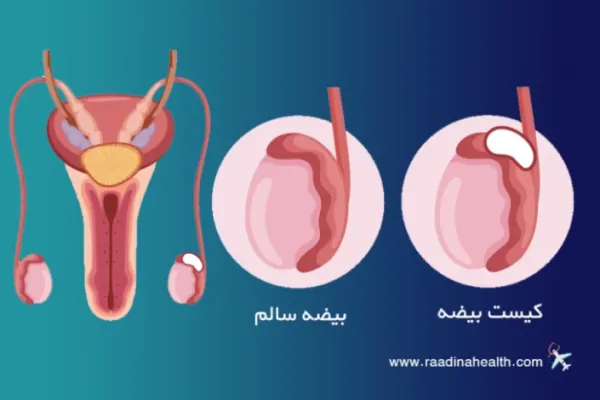  کیست خونی روی پوست بیضه