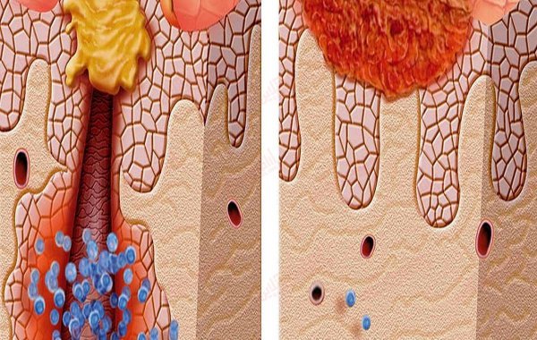  کیست خونی روی پوست بیضه