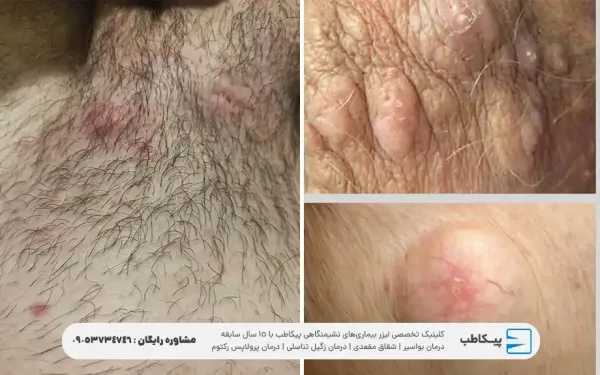  کیست خونی روی پوست بیضه