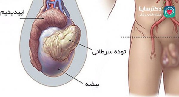  عکس سرطان بیضه