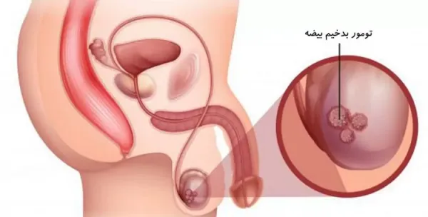  عکس سرطان بیضه