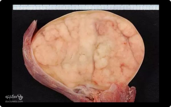  عکس سرطان بیضه