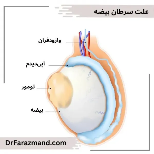  عکس سرطان بیضه