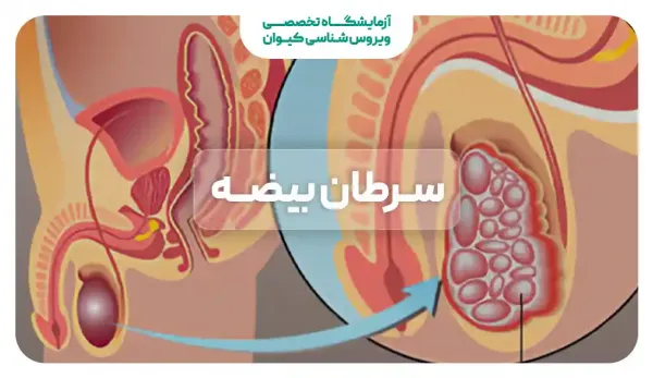 علائم سرطان بیضه پیشرفته