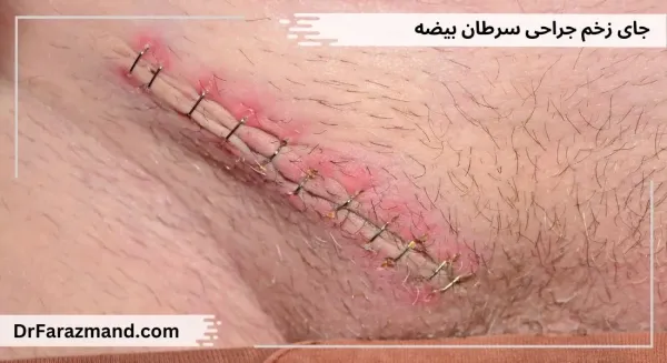  علائم سرطان بیضه پیشرفته