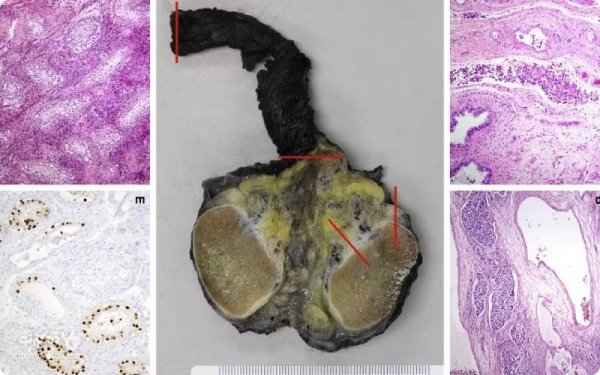  علائم سرطان بیضه پیشرفته