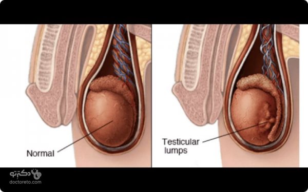  علائم سرطان بیضه پیشرفته