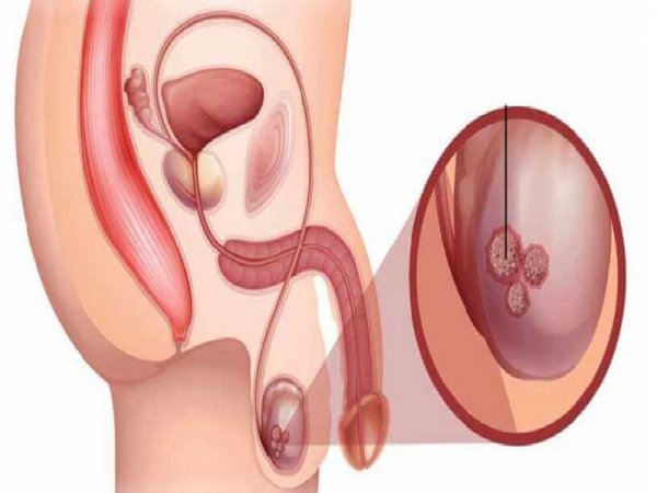  تفاوت کیست و سرطان بیضه