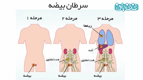  تفاوت کیست و سرطان بیضه