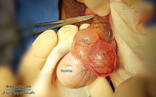  برای کیست بیضه به چه دکتری مراجعه کنیم؟