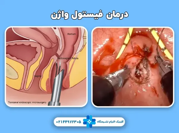  فیستول واژن در بارداری