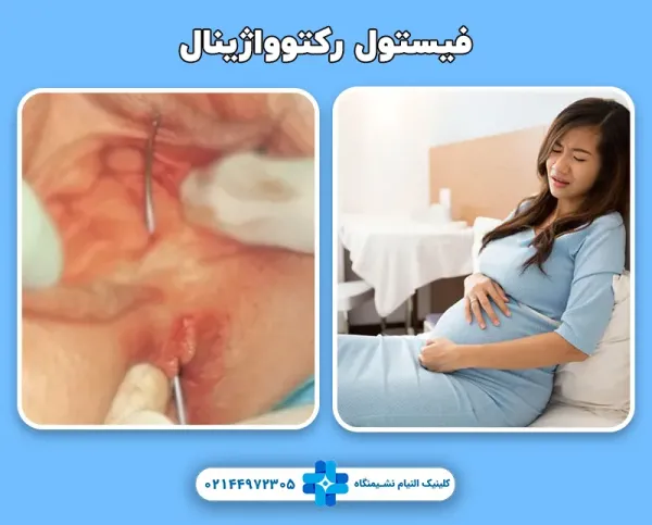  فیستول واژن در بارداری