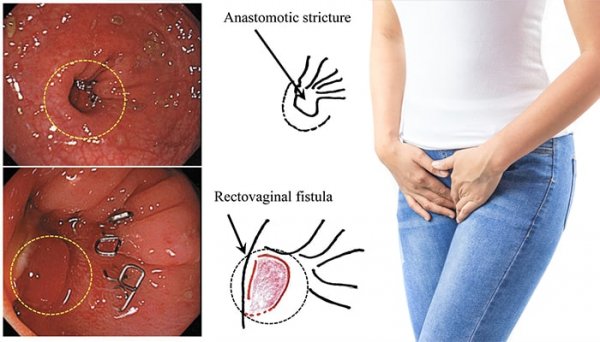  فیستول واژن در بارداری