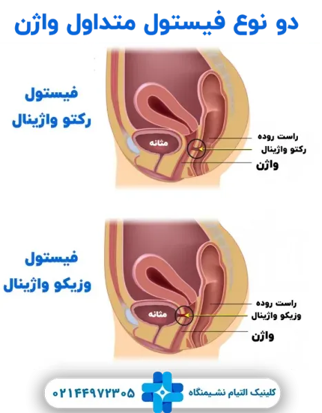  فیستول واژن در بارداری