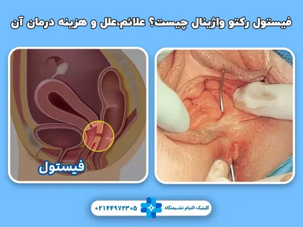  فیستول واژن در بارداری