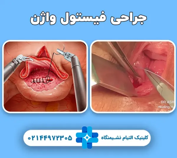 عمل جراحی فیستول واژن