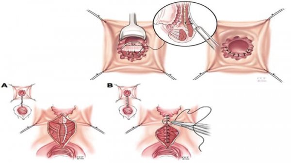  عمل جراحی فیستول واژن