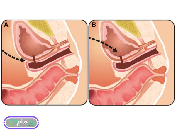  عمل جراحی فیستول واژن