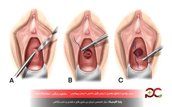  عمل جراحی فیستول واژن