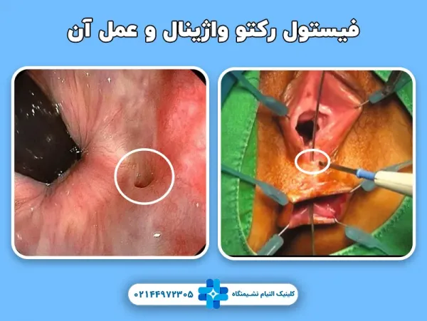  عمل جراحی فیستول واژن