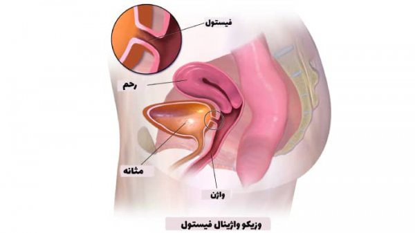  عمل جراحی فیستول واژن
