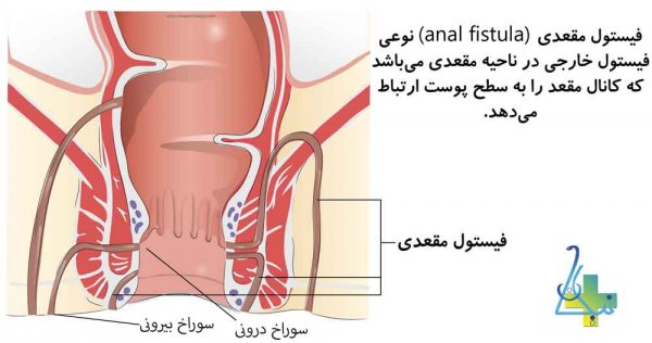  آیا فیستول درمان قطعی دارد؟