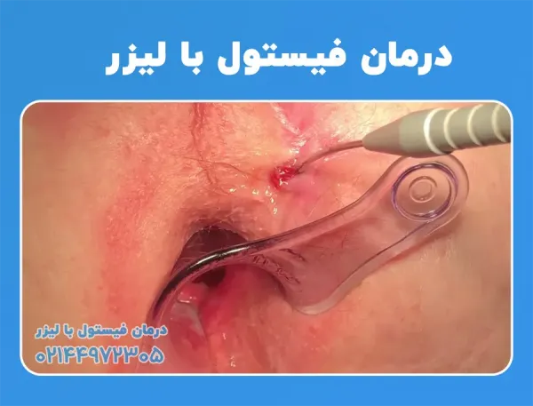 عمل فیستول با لیزر بهتر است یا جراحی