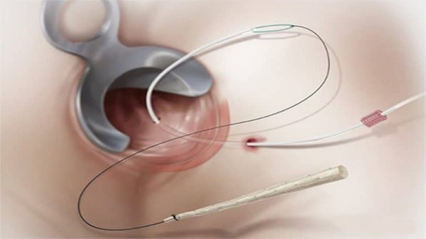  عمل فیستول با لیزر بهتر است یا جراحی