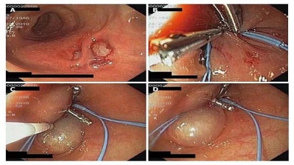  عمل فیستول با لیزر بهتر است یا جراحی