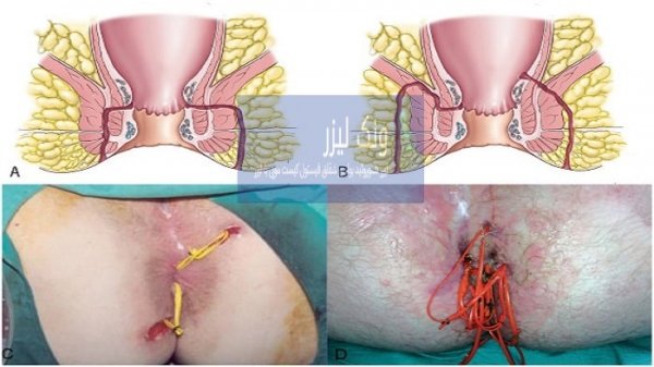  عمل فیستول با لیزر بهتر است یا جراحی