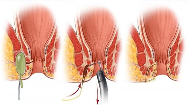 عمل فیستول با لیزر بهتر است یا جراحی
