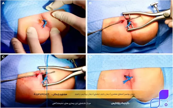  عمل فیستول با لیزر بهتر است یا جراحی