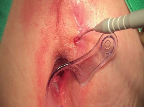  عمل فیستول با لیزر بهتر است یا جراحی