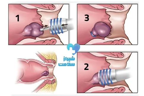  عمل فیستول با لیزر بهتر است یا جراحی