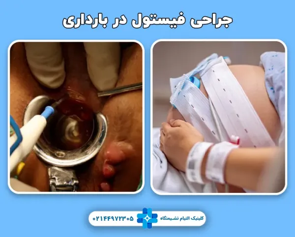 جراحی فیستول در بارداری