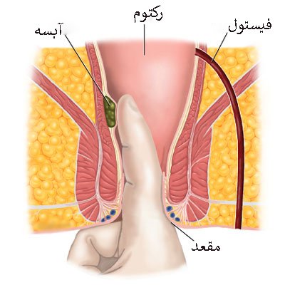  جراحی فیستول در بارداری
