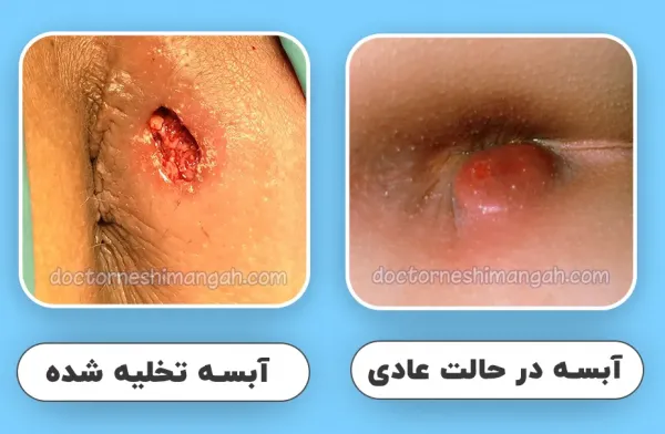  جراحی فیستول در بارداری