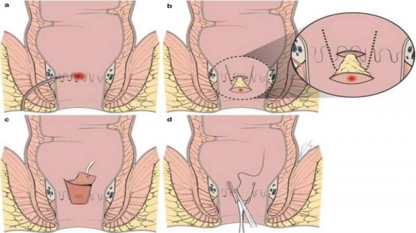  جراحی فیستول در بارداری