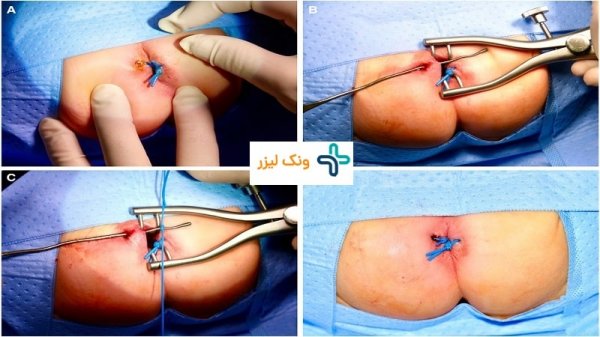  جراحی فیستول در بارداری