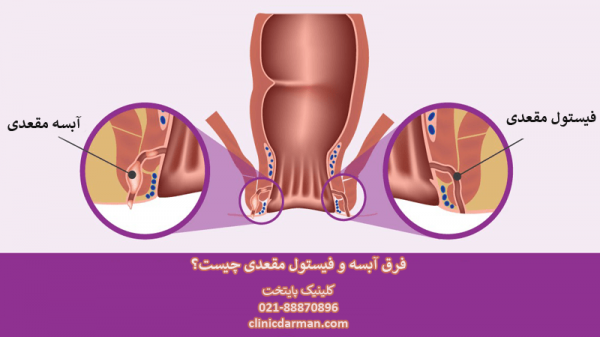  جراحی فیستول در بارداری