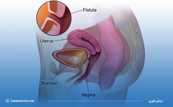  جراحی فیستول در بارداری