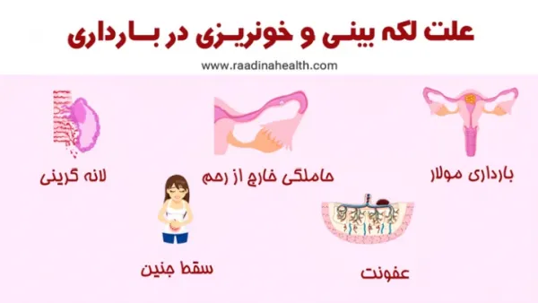  شیاف برای قطع خونریزی در بارداری