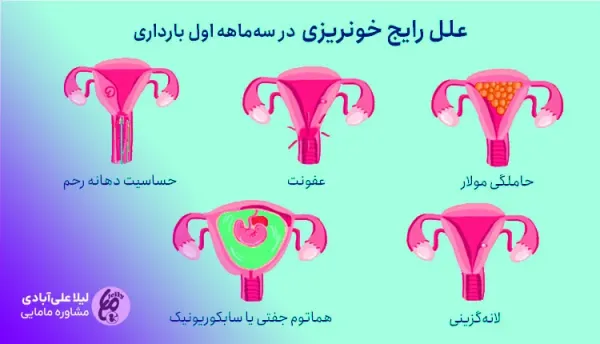  شیاف برای قطع خونریزی در بارداری