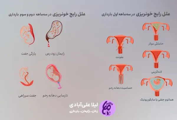  شیاف برای قطع خونریزی در بارداری