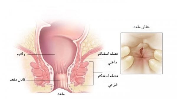  درمان خانگی شقاق در بارداری