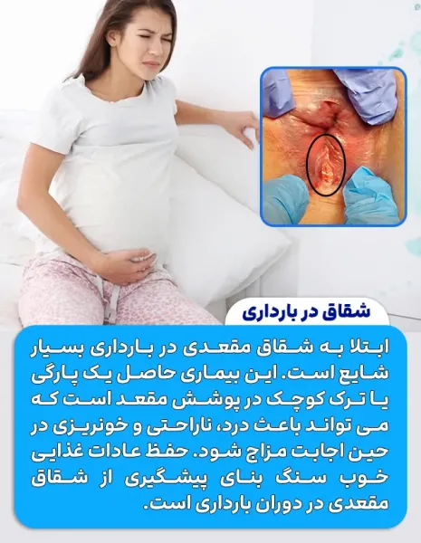  درمان خانگی شقاق در بارداری