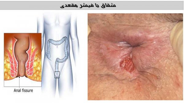  درمان خانگی شقاق در بارداری