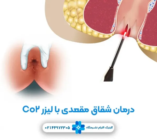 لیزر شقاق در بارداری